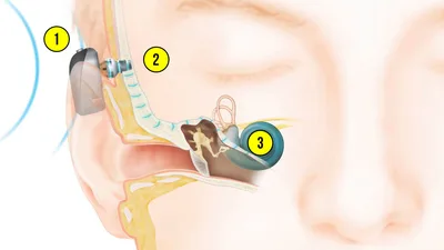 Детям в Кыргызстане вручат инновационные процессоры Cochlear